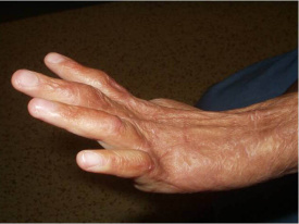 Dítě po závažném popáleninovém úrazu s jizevnatou deformitou ručičky