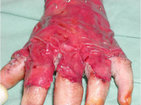 Pacient po odstranění jizev a aplikaci umělé kůže Integra