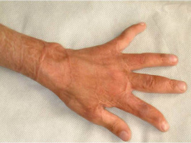 2 roky po aplikaci umělé kůže – dítě je bez omezení pohybu ruky jizvou s velmi dobrým kosmetickým efektem