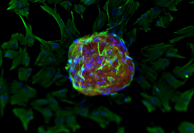 Organoid z pankreatického karcinomu (zeleně tumor-asociované fibroblasty, červeně karcinom). Kultivace organoidu a foto Dr. Stanislava Martínková.
