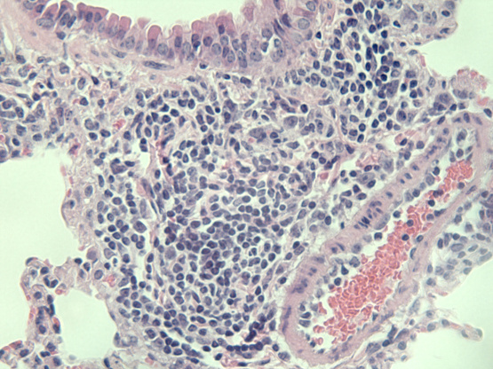 Chemicky vyvolaný karcinom plic. Samotný nádor zabírá centrální část snímku, vlevo nahoře je okraj průdušinky s typickými kuboidními buňkami nezasaženými zhoubným bujením, vpravo dole je pak céva s dobře patrnými růžově obarvenými bezjadernými červenými krvinkami uvnitř.