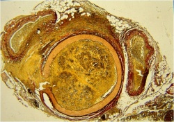 Obr. 3: Histologický obrázek poškozené cévy po průchodu elektrickým proudem